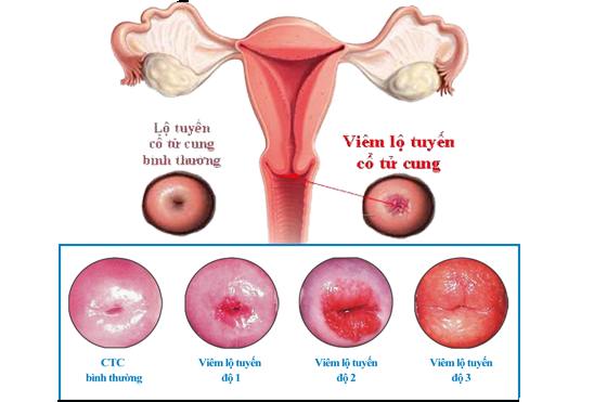 Bệnh Phụ Khoa Phổ Biến - Viêm Lộ Tuyến Tử Cung