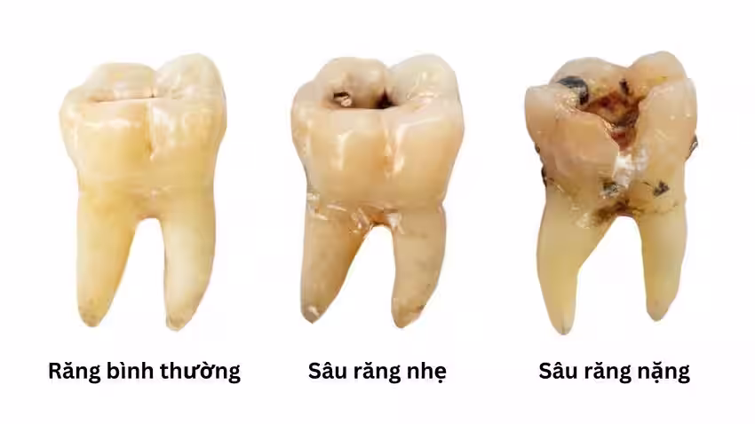 giai đoạn của sâu răng
