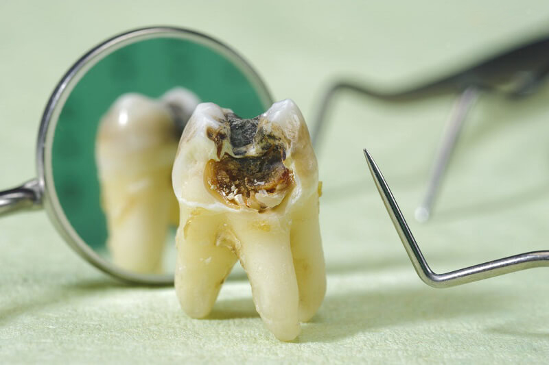 Biến chứng của sâu răng